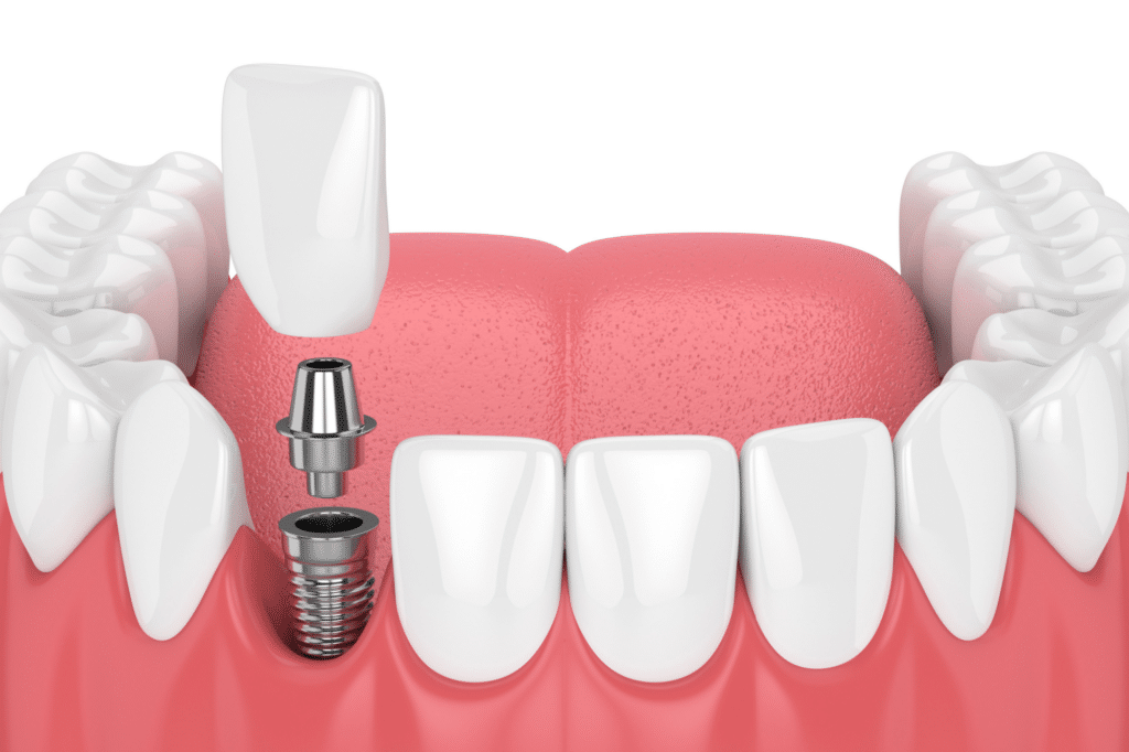 Dental Implants Buhl Dr. Don S. Wyatt, DDS, Dr. Jeremiah Funk, DMD, Dr. Ty Peterson, DMD. General Dentist, Cosmetic, Restorative, Preventative, Family Dentist, Cosmetic Dentistry, Implants, Full Mouth Restorations, All on 4's. 5's,X, Dentures, Clear Aligners, Sedation Dentistry . Dentist in Dentists in Buhl, Jerome, Wendell & Gooding ID